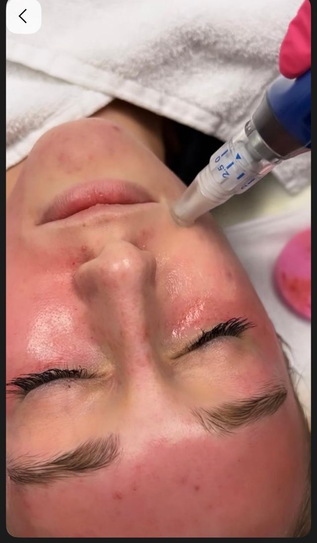 Cuidado facial: Dermapen, Baby Glow