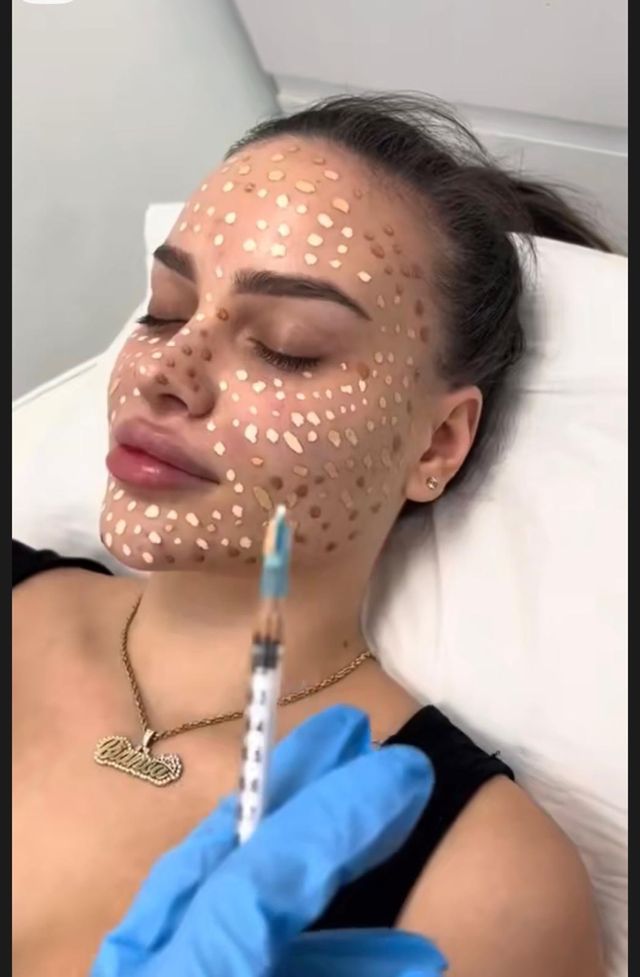 Cuidado facial: Dermapen, Baby Glow