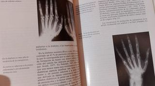 Osteoporosis , Rico Lenza