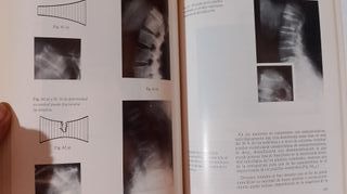 Osteoporosis , Rico Lenza