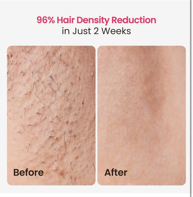 SALOOT Trinity iGlow 10 - Depiladora láser