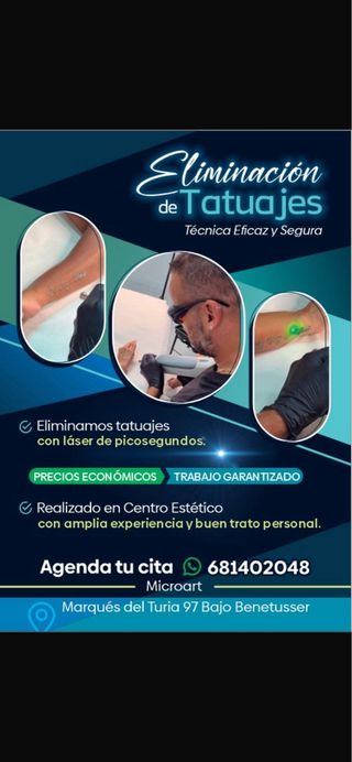 eliminación de tatuajes ha láser.