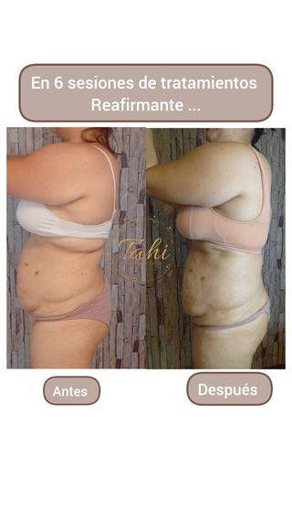 Sesiones de reducción de medidas 