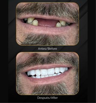 CARILLAS DISEÑO DE SONRISA 
