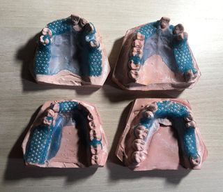 Modelos dentales de escayola prótesis II.