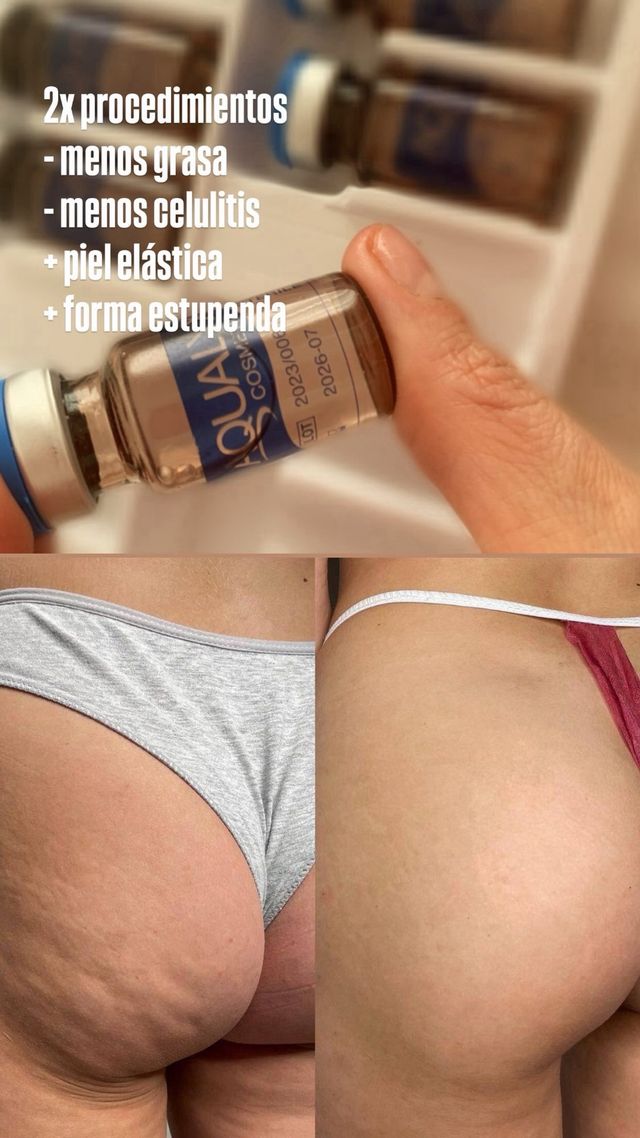 eliminación de grasa corporal y facial