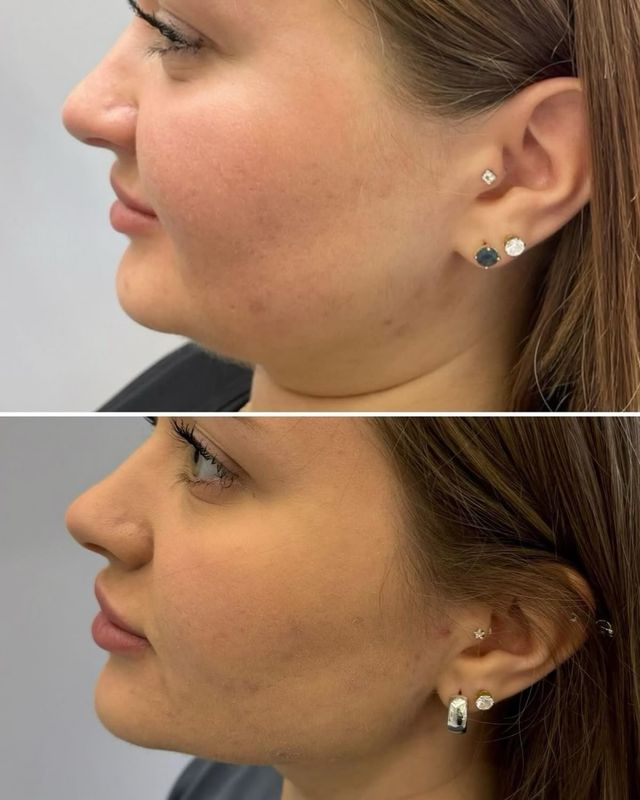 eliminación de grasa corporal y facial