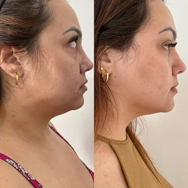 eliminación de grasa corporal y facial