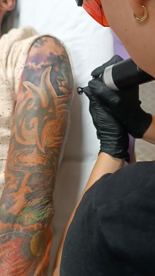 Eliminación tatuajes y carbón peel