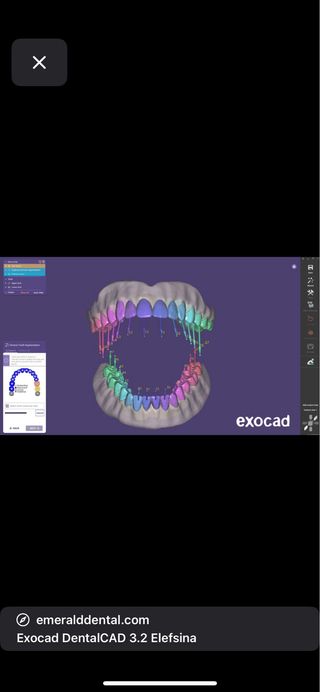 Installazione assistita exocad