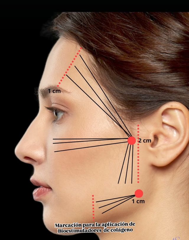 Tratamientol PLLA 365mg inductores de colágeno.