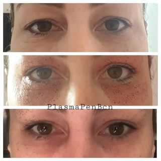  Micropigmentacion y Plasma para arrugas