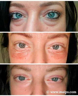  Micropigmentacion y Plasma para arrugas