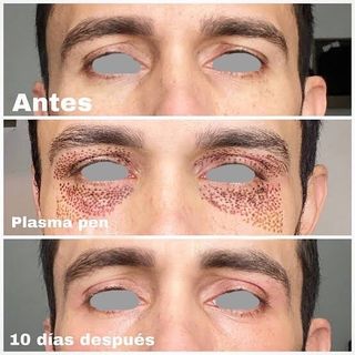  Micropigmentacion y Plasma para arrugas