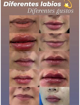 Aumento de labios