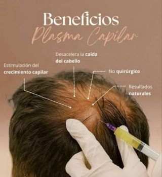 MASOTERAPIA CAPILAR CON PLASMA RICO EN PLAQUETAS
