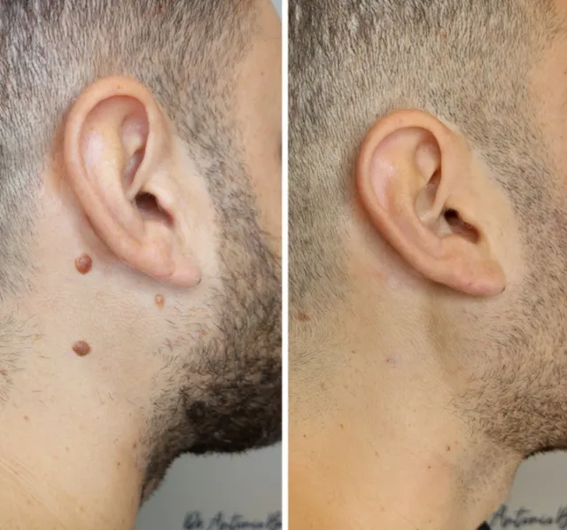 Eliminación de Verrugas