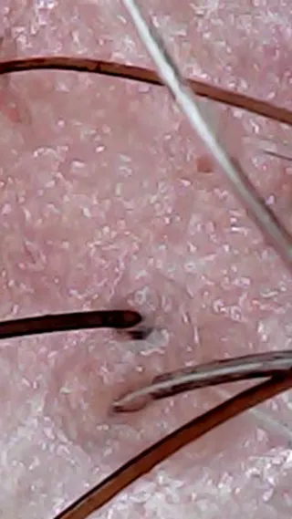 Microcamara piel, Diagnóstico y cuidado capilar y