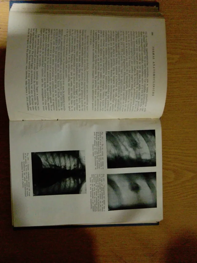 Formas Anatomoclonicas de la tuberculosis pulmonar