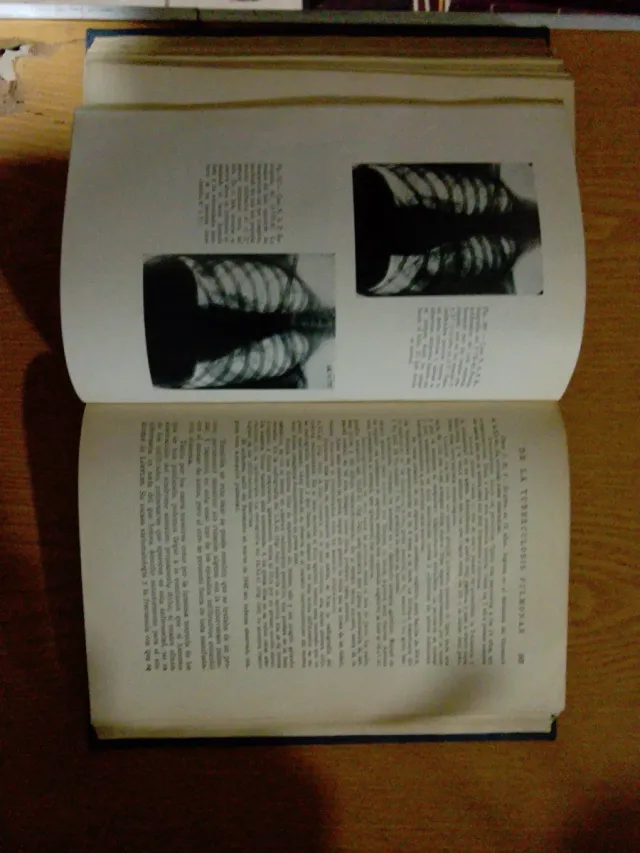 Formas Anatomoclonicas de la tuberculosis pulmonar