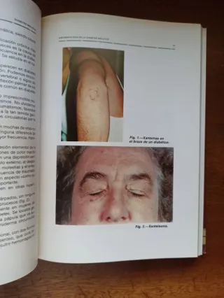 Las Diabetes Mellitus