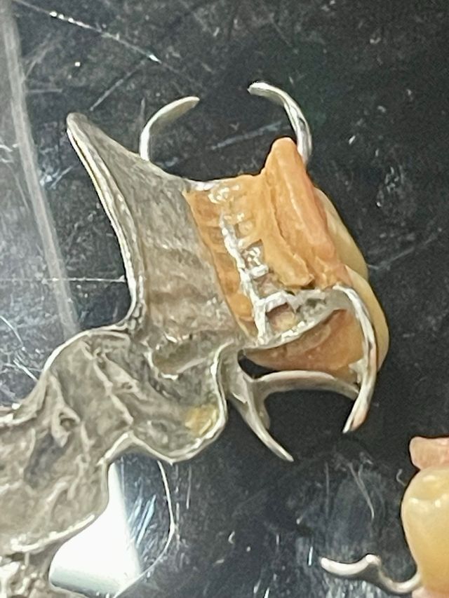 Antigua prótesis dental metálica