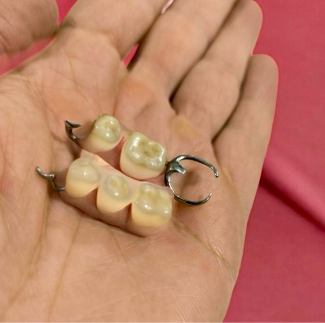 Antigua prótesis dental metálica