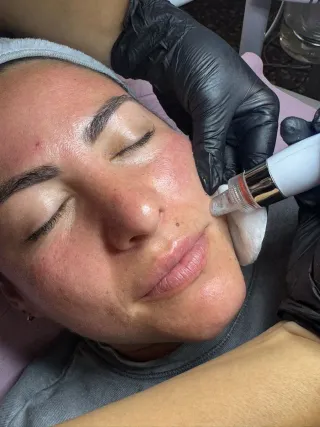 ✨ LIMPIEZA FACIAL PROFUNDA + HIDROFACIAL DERMAPEN