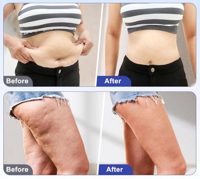 Massaggiatore 4 in 1 Anticellulite Tonificante New