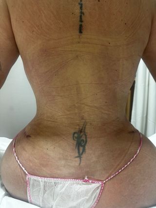 Masajes reductores, postoperatorios y linfáticos