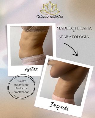 Tratamiento Reductor/Moldeador Salazar Esthetic