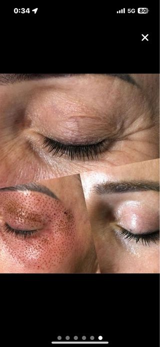 maderoterapia,radiofrecuencia,plasma pen