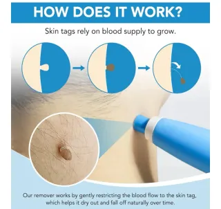 Kit removedor automático de verrugas