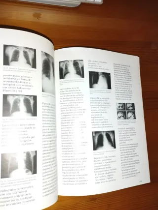 Libro de medicina Tuberculosis
