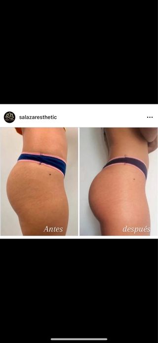 Masaje anticelulitis/levantamiento de glúteos.