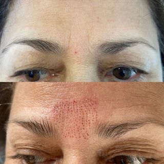 Fibroblast entrecejo