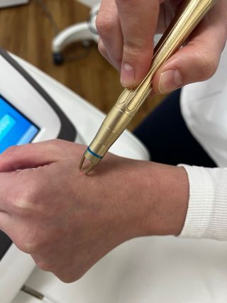 Láser para arañas vasculares