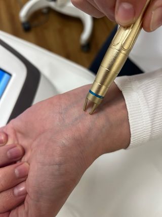 Láser para arañas vasculares