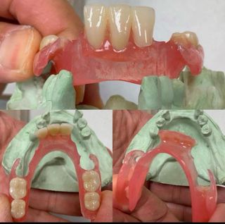 Prótesis dental presupuesto 50%