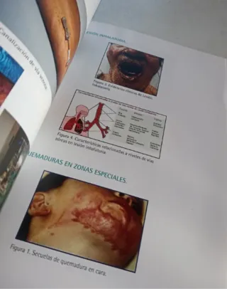 Atención de Enfermería al paciente con quemaduras