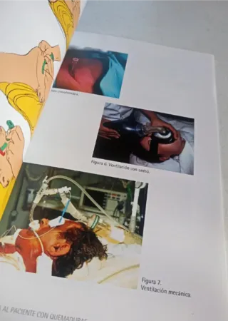 Atención de Enfermería al paciente con quemaduras