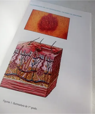 Atención de Enfermería al paciente con quemaduras