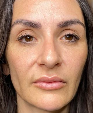 Curso Fibroblast con Certificado a distancia