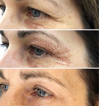 Tratamiento Fibroblast Párpados