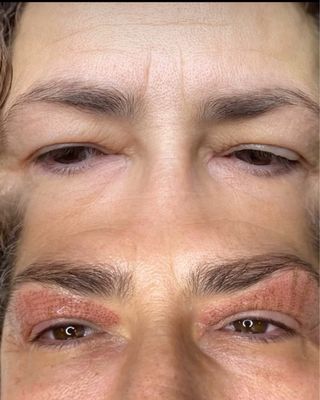 Tratamiento Fibroblast Párpados