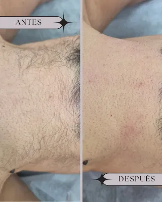 Depilación Láser