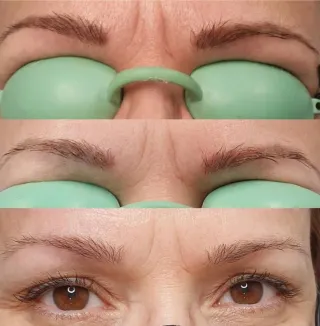 Eliminación de micropigmentación de cejas en BCN