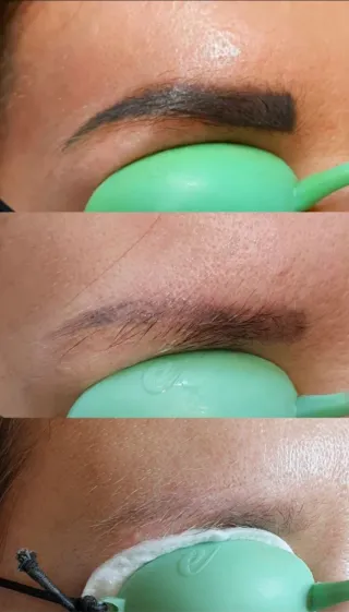 Eliminación de micropigmentación de cejas en BCN