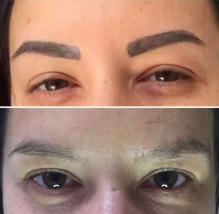 Eliminación de micropigmentación de cejas en BCN