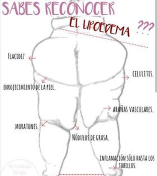 36€.LIPEDEMA, MASAJES TERAPEUTICOS  A DOMICILIO.